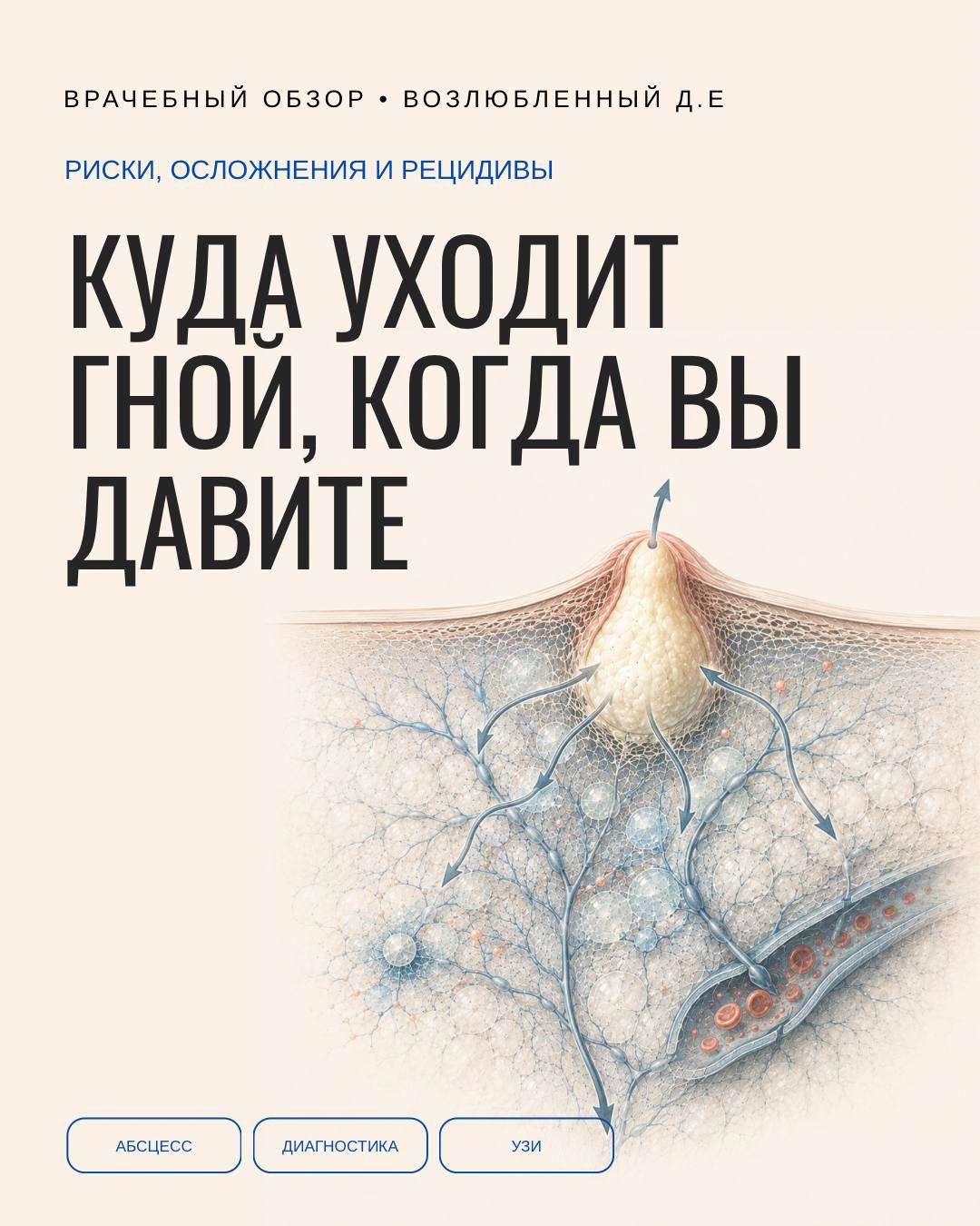 Куда на самом деле уходит гной, когда вы давите
