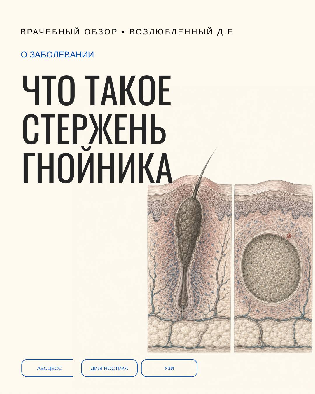 Что такое «стержень» гнойника — и почему он есть не у каждого